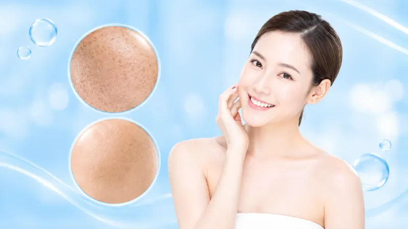 C&ocirc;ng nghệ Discovery Pico Derm VarioPulse cải thiện hiệu quả n&aacute;m v&agrave; rối loạn sắc tố