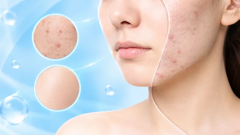 Discovery Pico Derm VarioPulse gi&uacute;p điều trị sẹo mụn v&agrave; t&aacute;i tạo bề mặt da hiệu quả