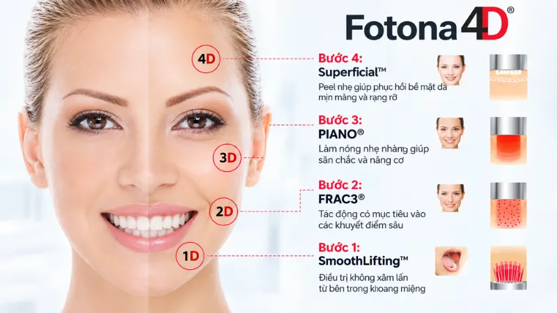 Laser Fotona 4D kết hợp 2 bước sóng laser thông qua 4 chế độ điều trị chuyên biệt