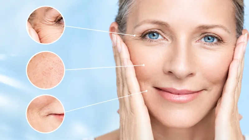 Giảm nếp nhăn nhờ tái tạo collagen và co rút mô