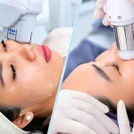 So Sánh CFU Và HIFU: Nên Chọn Công Nghệ Nào Cho Nâng Cơ Trẻ Hóa Da