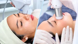 So Sánh CFU Và HIFU: Nên Chọn Công Nghệ Nào Cho Nâng Cơ Trẻ Hóa Da