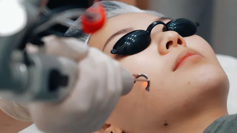 Laser Pico ít đau, còn Laser CO2 Fractional gây nóng rát rõ hơn