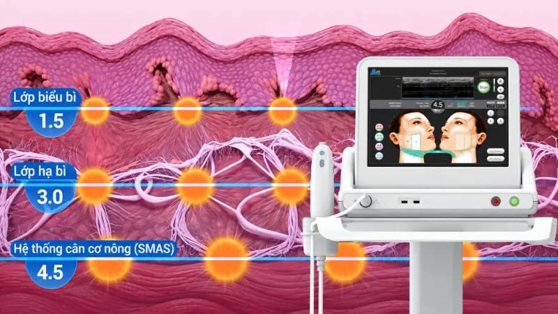 Sóng siêu âm MFU đi xuyên qua bề mặt da mà không gây tổn thương mô xung quanh