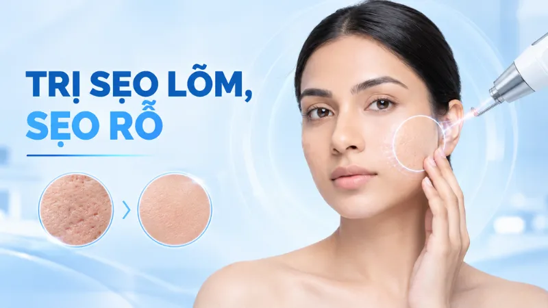 L&agrave;m mờ hiệu quả c&aacute;c loại sẹo mụn nhờ cơ chế ph&aacute; vỡ m&ocirc; sẹo cũ, th&uacute;c đẩy da tự l&agrave;nh