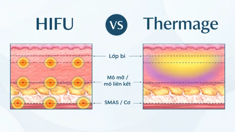 HIFU nâng cơ sâu bằng siêu âm hội tụ, Thermage căng da bằng sóng RF đa tầng