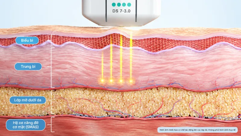 Ultherapy sử dụng sóng siêu âm hội tụ vi điểm tác động sâu đến lớp SMAS