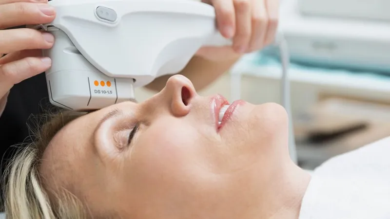 Thực hiện Ultherapy trán gây cảm giác châm chích, hơi ê hoặc nóng sâu